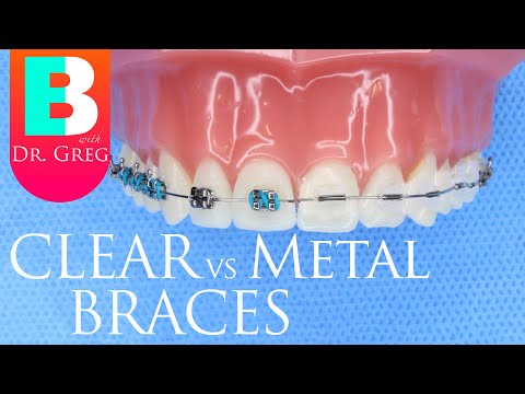 download lagu mp3 mp4 Are Ceramic Braces Better Than Metal, download lagu Are Ceramic Braces Better Than Metal gratis, unduh video klip Are Ceramic Braces Better Than Metal