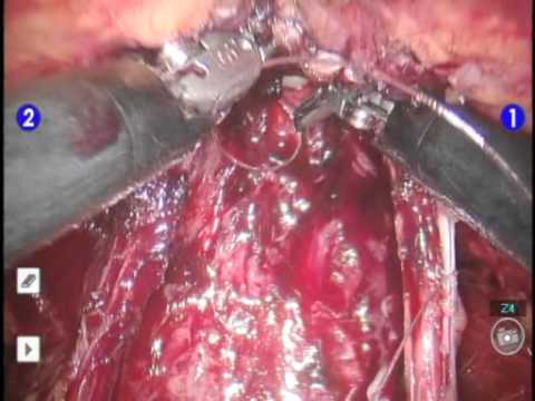 Prostate Resection