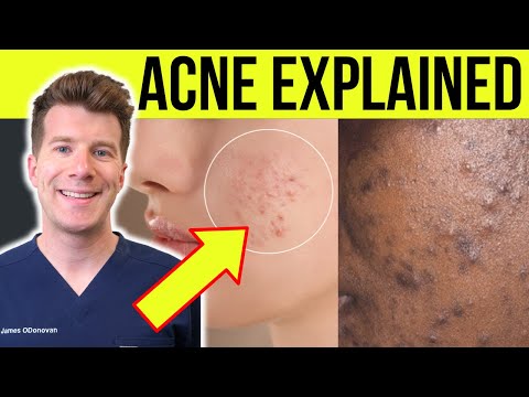 Arzt erklärt AKNE | Ursachen, Symptome, Behandlung und mehr!