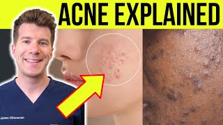 Download lagu Doctor explains ACNE | Causes, symptoms, treatment and more! mp3