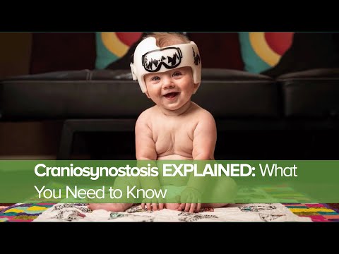 Craniosynostosis Explained What You Need To Know