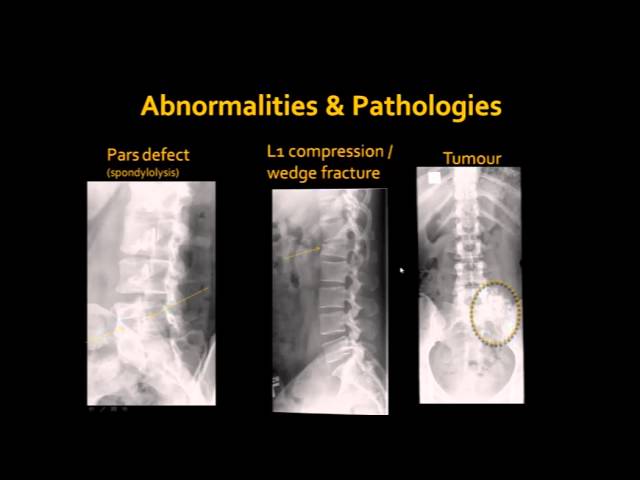 Vertebral Pathologies Understanding Common Vertebral Column Abnormalities in Radiology | Magica