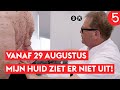Nieuw bij RTL5: Mijn Huid Ziet Er Niet Uit!