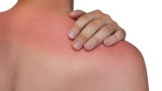 How To Treat and Prevent Heat Rash | Rachael