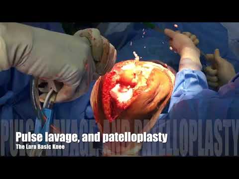 Essential Steps Of A Cemented Total Knee Replacement