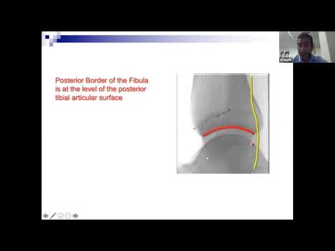 Fundamentals of Orthopaedics Session 15 Part 2 - Ankle Fractures