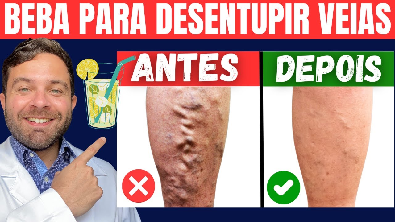 5 AMAZING DRINKS | COMBAT POOR CIRCULATION, VARICOSE VEINS and LEG PAIN