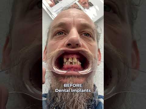 Before And After Smile Transformation! 🤯 Full Mouth Dental Implants! 🦷✨ #shorts