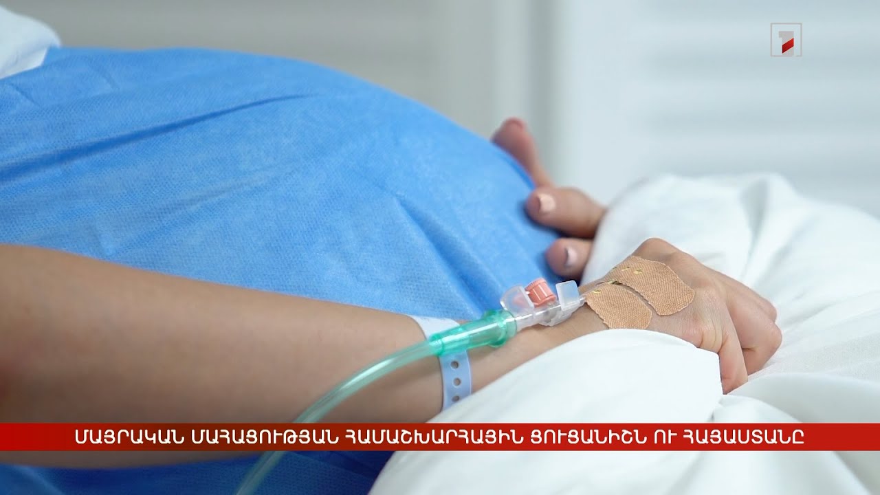 Մայրական մահացության համաշխարհային ցուցանիշը նվազել է. Հայաստանի պատկերը