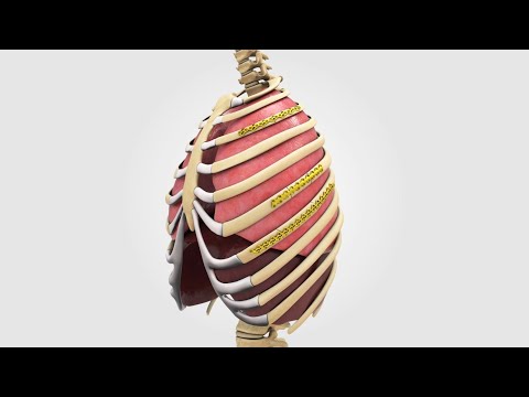 L1®  Rib osteosynthesis system featuring CB3 technology