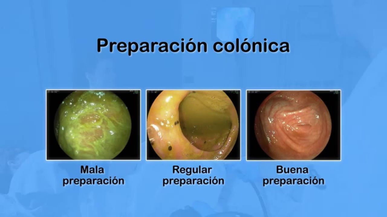 Vídeo sobre Colonoscopia del programa de prevención de cáncer colorrectal.