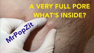 Very full pore! Let’s see what’s inside. Do you think it’s just a clogged pore or is there a sac?