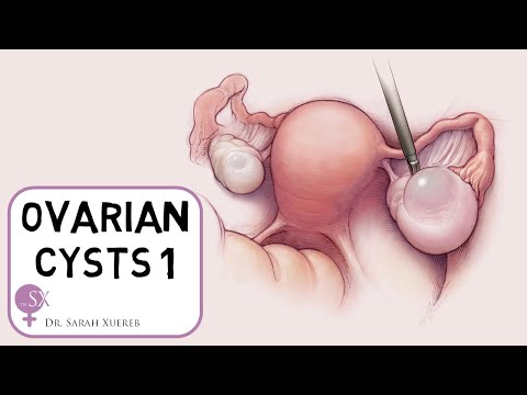 Ovarian Cysts Explained | Classification, Presentation & Ovarian Cyst Accident