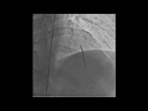BICTO Series (Bifurcation &CTO) 6: LAD ostial CTO and LAD/D1 Bifurcation lesion.