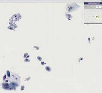 Pathology Outlines - Atrophy
