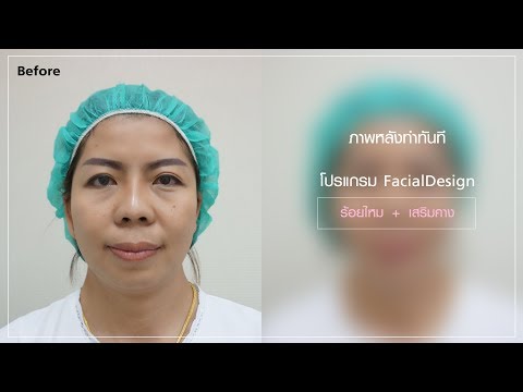 ร้อยไหม หน้าเรียว
