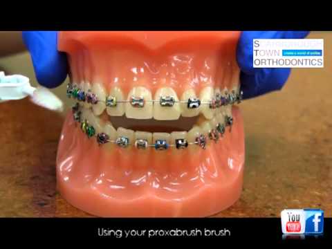 Oral Hygiene Instructions while in braces