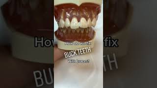 How we fix BUCK TEETH 🦷