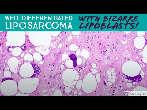 Well differentiated liposarcoma with BIZARRE pleomorphic lipoblasts! 5-Minute Pathology Pearls