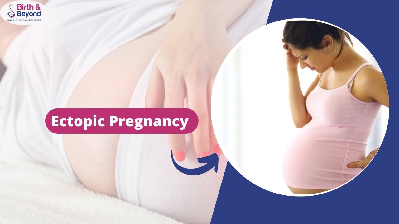 Ectopic Pregnancy