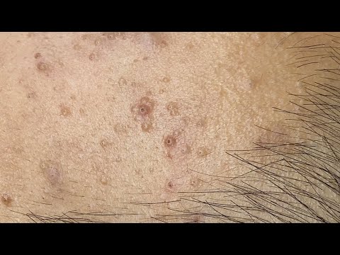 Blackhead Removal – Watch as Stubborn Pores Get Cleansed!