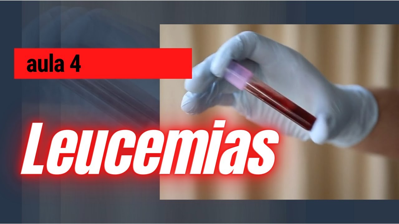 LEUCEMIAS - AULA 4 - Hematologia