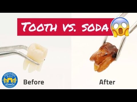 Will Soda Ruin Your Teeth? - Soda Vs Tooth Experiment