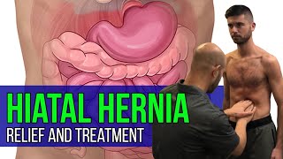 Hiatal Hernia Relief and Treatment (Sliding Hernia)