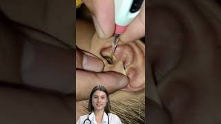 Ear Wax Removal #2