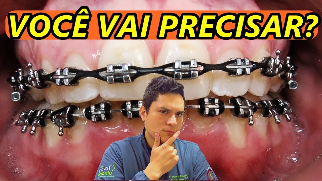 Watch Now DESCUBRA SE VOCÊ VAI PRECISAR DE ELÁSTICOS EM CORRENTE! DESCUBRA SE VOCÊ VAI PRECISAR DE ELÁSTICOS EM CORRENTE!