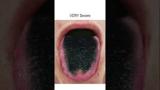 Black Hairy Tongue Progression