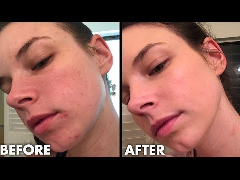 download lagu mp3 mp4 7 Skin Method Acne, download lagu 7 Skin Method Acne gratis, unduh video klip 7 Skin Method Acne