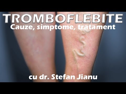 tipul de operare varicoza