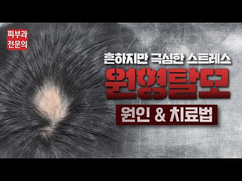 원형 탈모로 빠진 머리, 다시 자라날 수 있을까? 원형탈모 원인과 치료방법!