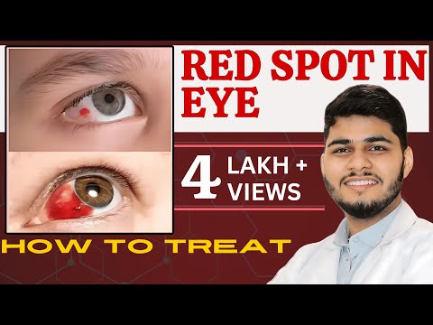 Blood spot in eye reasons |How to treat blood spot in eye | Subconjunctival haemorrhage
