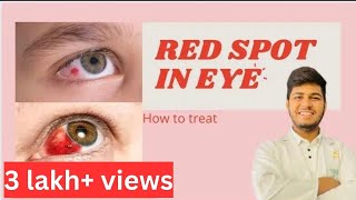 Blood spot in eye reasons |How to treat blood spot in eye | Subconjunctival haemorrhage