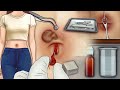 Belly Button Naval Cleaning ASMR Animation Belly Button Piercing Infection Treatment Animation
