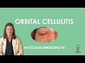 Orbital Cellulitis an ocular emergency!