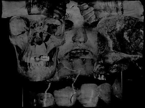 Phlegmsepsia \ Atrial Septic Defect split