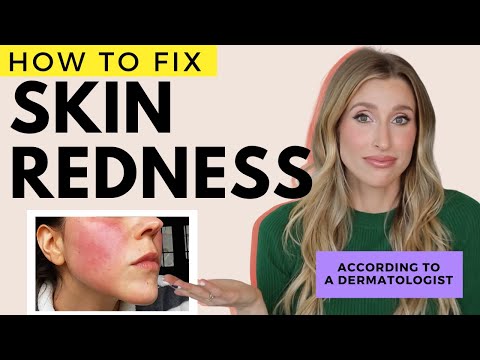 Fix Redness on the Face and Body | Dr. Sam Ellis