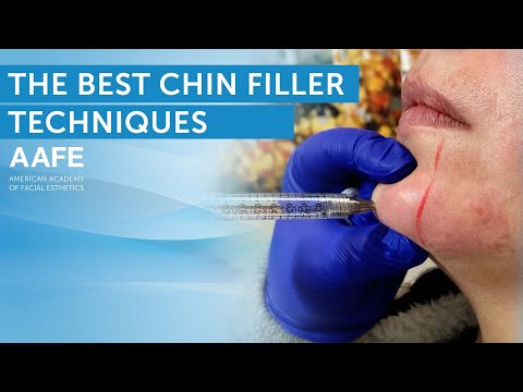 Chin Filler Tutorial & The Best Techniques