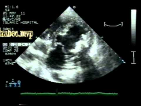 Tiger heart: A  Variant Of  Left Ventricular Noncompaction (LVNC)?