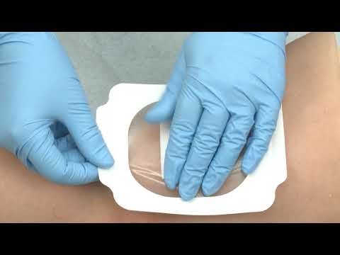 Molnlycke | Mepitel film instructievideo