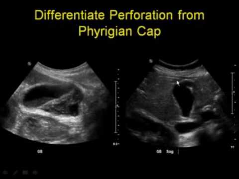 Errors in Gallbladder Ultrasound