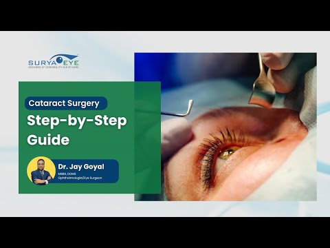 Cataract Surgery Steps Explained by Dr. Jay Goyal – Safe, Painless & Quick Procedure