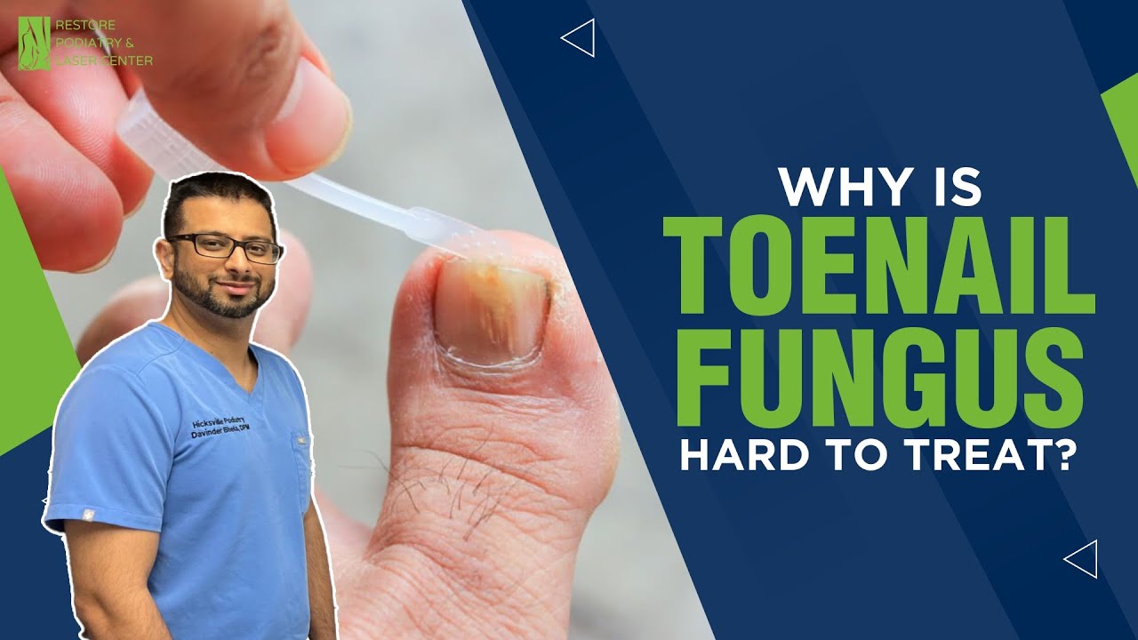 Why is Toenail Fungus Hard To Treat? #ToenailFungus #FootCare #Podiatrist #DrBhela #NewYork