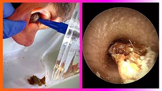 Why is this EAR WAX Removal so Satisfying? - Oddly Satisfying Video With Calming Music