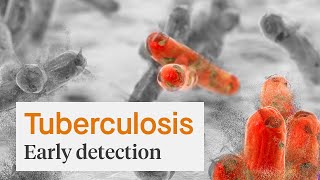 Early Detection of Tuberculosis