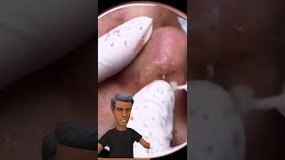 big blackheads remove from nose #blackheads #acne#acnetreatment #pimplepopping