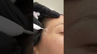 #shorts Eliminación de verrugas con plasma láser | Clínicas Be 😍 #trends